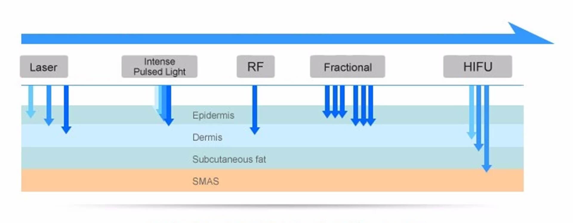 Nâng cơ vùng mắt Ultherapy Abbas Max